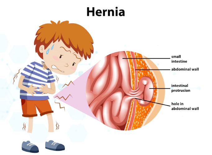 hernia_new