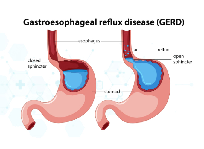 reflux