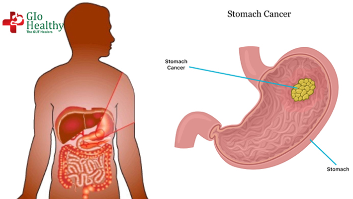 abdominal_cancer