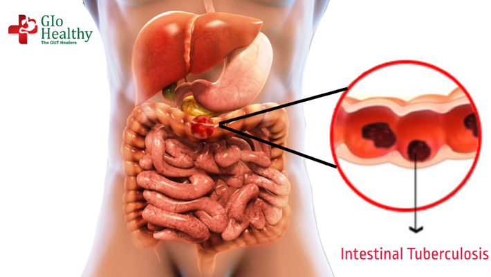 abdominal_tuberculosis
