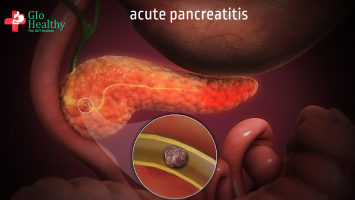 acute_pancreatitis