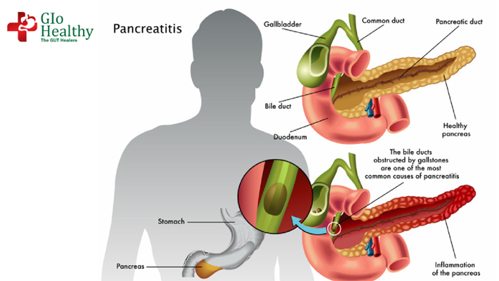 chronic-pancreatitis