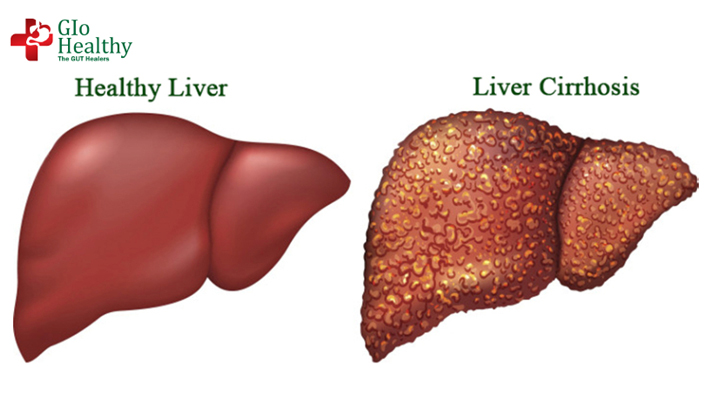 cirrhosis-of-the-live