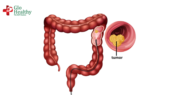 colorectal-cancer