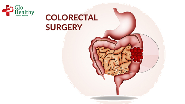 colorectal_surgeries