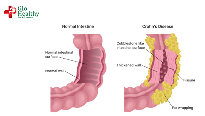 crohns-disease