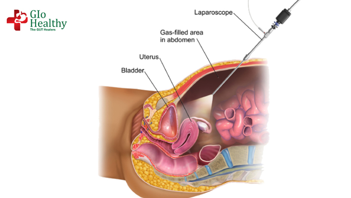 diagnostic-laparoscopy