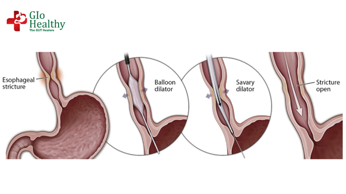 esophageal-stricture