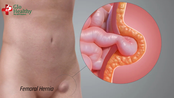 femoral_hernia
