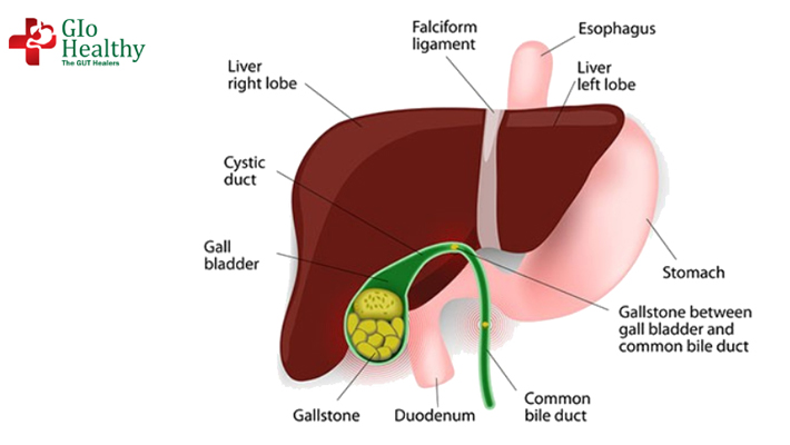 gall_bladder_stones