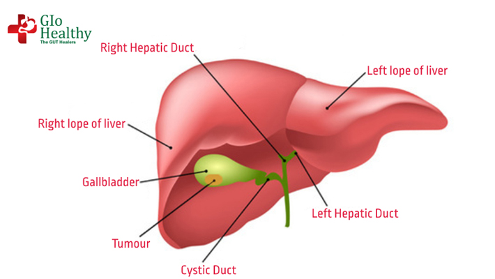 gallbladder-cancer