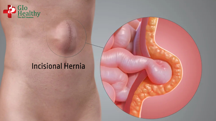 hiatus-hernia