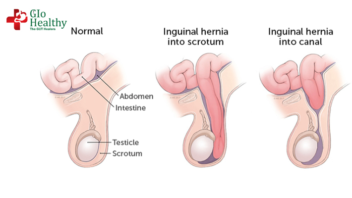 inguinal-hernia