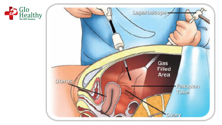 inguinal_hernia
