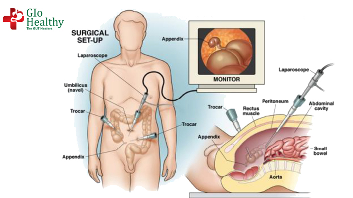 laparoscopic-appendectomy