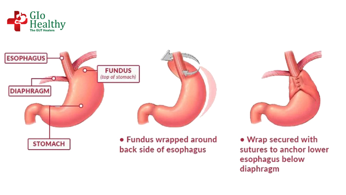laparoscopic-fundoplication