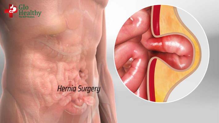 laparoscopic-hernia-surgery