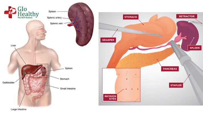 laparoscopic-splenectomy