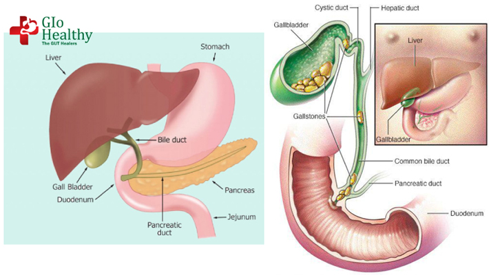 laparoscopic_cholecystectomy
