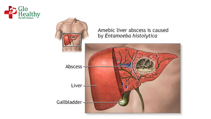 liver-abscess