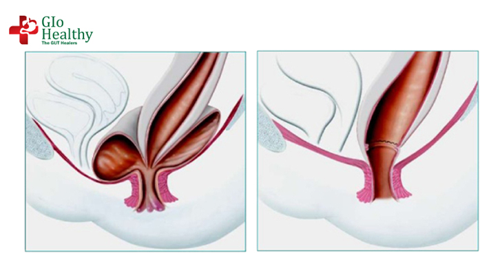 Obstructive defecation syndrome