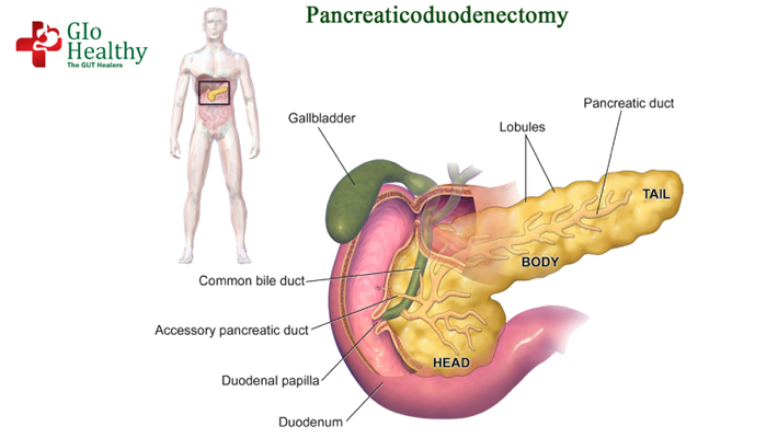 pancreaticoduodenectomy