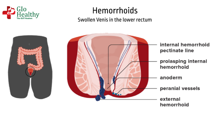 piles-hemorrhoids
