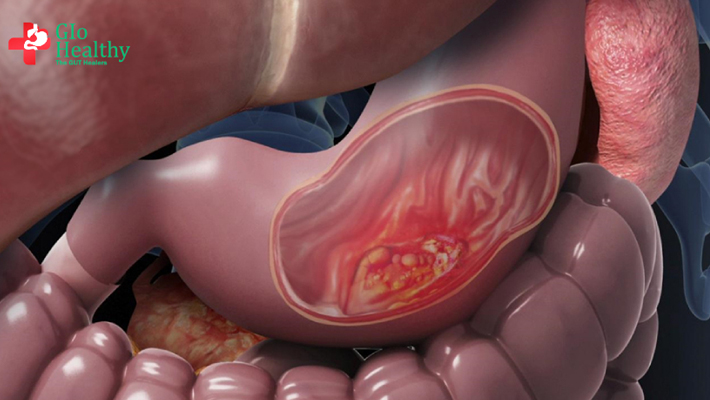 stomach-gastric-cancer