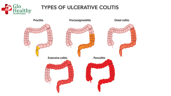 ulcerative_colitis