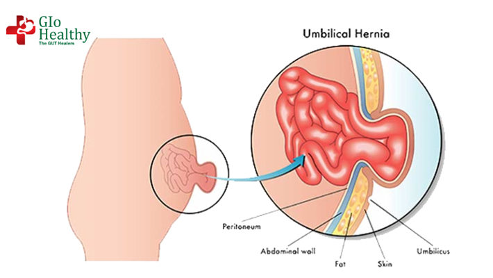 umbilical-hernias