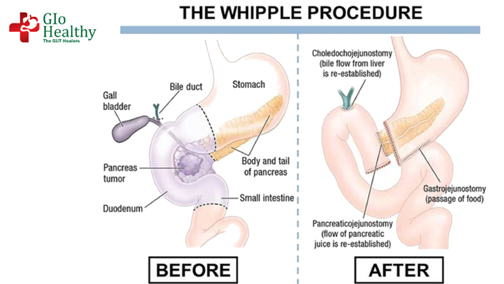 whipples-procedure